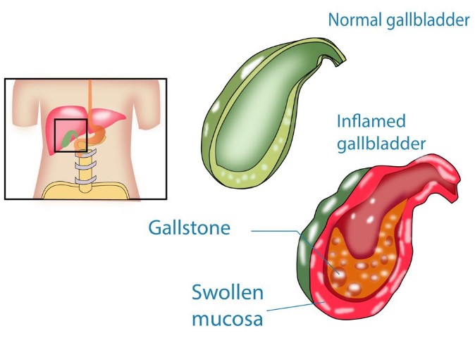 Cholecystitis (Gallbladder Inflammation)