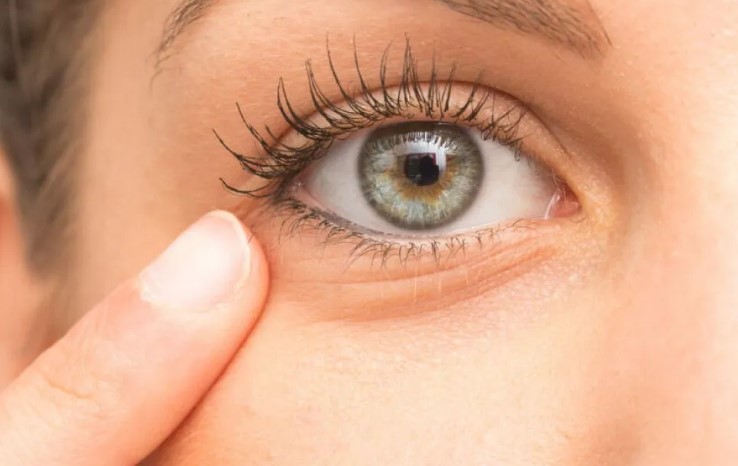 Blepharitis: Understanding and Managing This Common Eye Condition